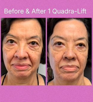 Quadra Lift Treatment